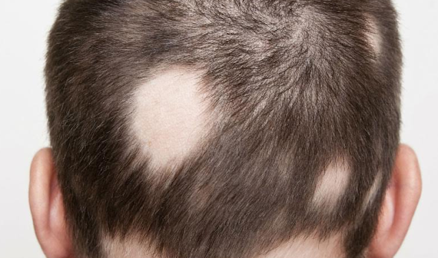 8 Motivos Para La Caída Del Cabello En Mujeres Y Hombres