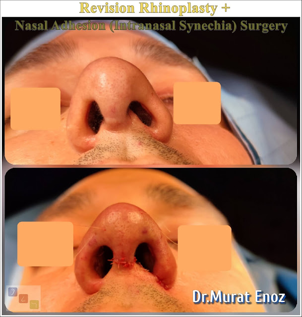 revision rhinoplasty + nasal adhesion removal surgery + septoplasty + nasal bone spur excision