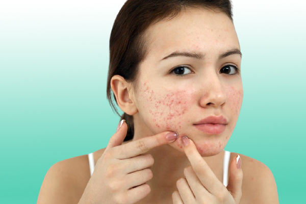 Cheapest Home Remedies To Cure Acne!