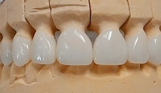 Quy trình bọc răng sứ tại nha khoa-2