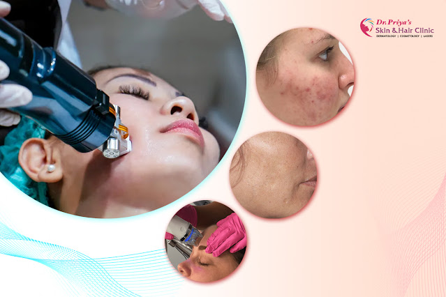 Best Microneedling Radiofrequency In Bangalore