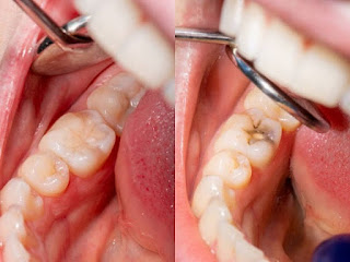 Lời giải đáp răng cấm bị sâu có nên nhổ bỏ hay không-3
