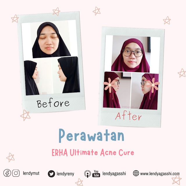 Bagaimana Setelah 1 Minggu Perawatan Comedoless dan Poreless ERHA Ultimate Acne Cure?