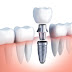 Read Before You Get Dental Implantation Done