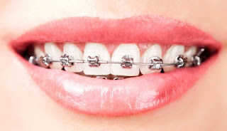 Quy trình niềng răng mắc cài kim loại-1