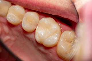 Lời giải đáp răng cấm bị sâu có nên nhổ bỏ hay không-2