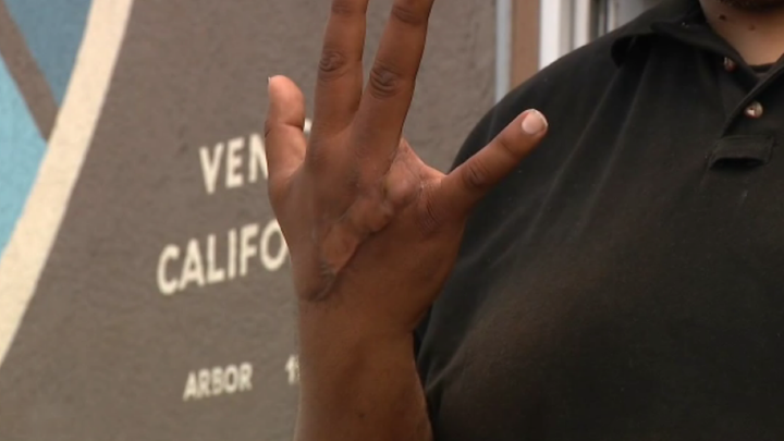 Los Angeles security guard speaks out about homeless crisis after losing finger in attack