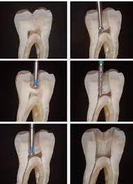 apertura dental para eliminar dolor