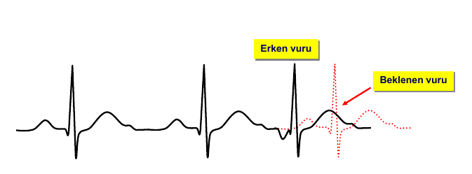 prematüre-atriyal-kompleks