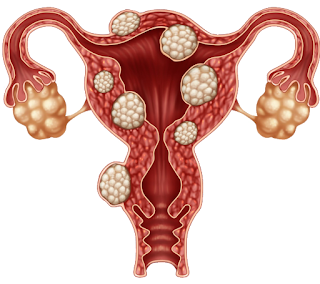 Endometriose, aandoening van het endometrium, baarmoederslijmvlies groeit buiten de baarmoeder