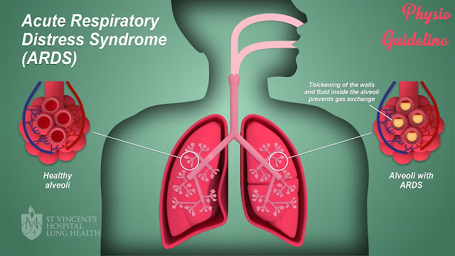 Acute Respiratory Distress