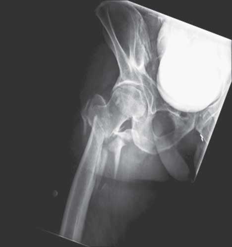 AP radiograph of the right hip