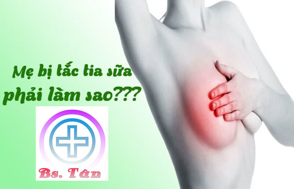 Mẹ Sau Sinh Bị Tắc Tia Sữa Phải Làm Sao