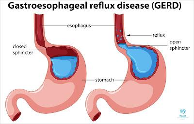 gastrointestinal reflux disease