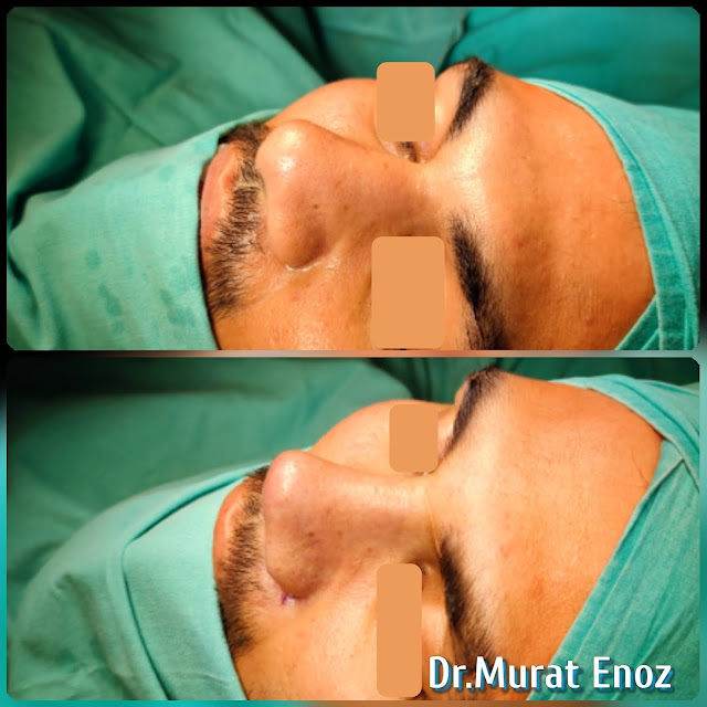 Natural nose aesthetic surgery for male,Male thick skinned rhinoplasty,Ethnic expert rhinoplasty surgeon,Ethnic Rhinoplasty in Istanbul,