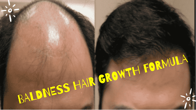 Grow Long Hair, 100% Natural Hair Loss Treatment, Cure Baldness, Remove Dandruff Thin Hair Hair Fall-01