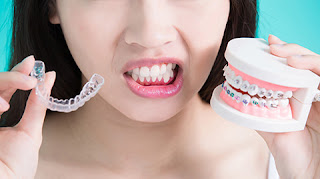 Bác sĩ tranh luận niềng răng có cần nhổ răng không-1