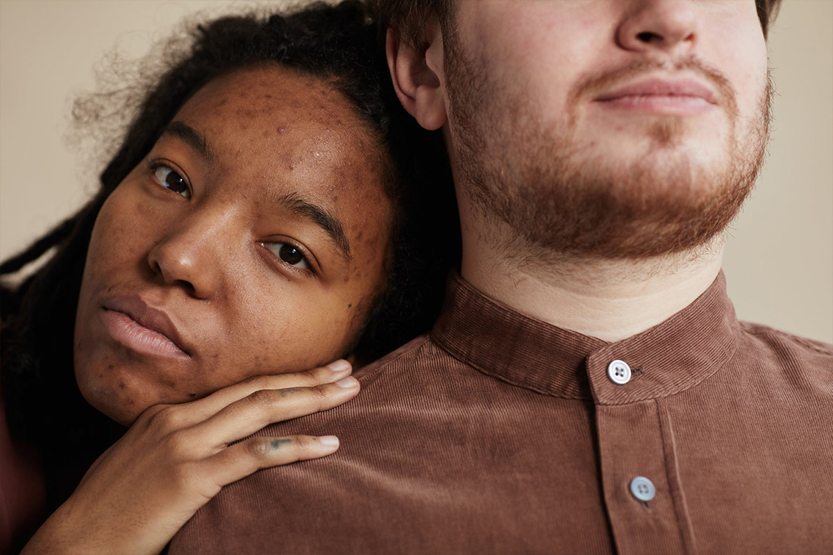 a close-up picture of the couple with acne and acne scarring