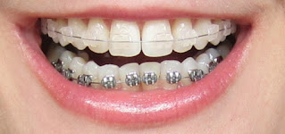 Niềng răng không nhổ răng phổ biến-1