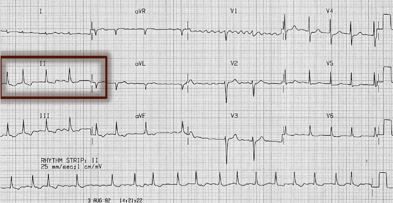 atriyal-fibrilasyon-degerlendirme-ekg