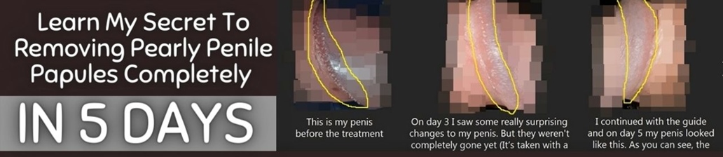 Pearly Penile Papules No More