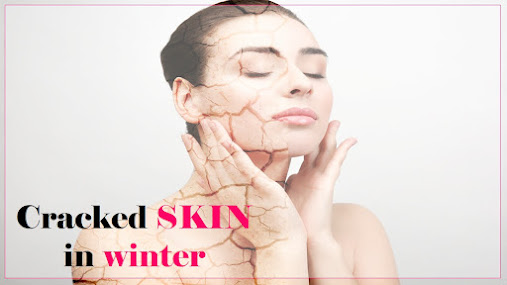 How to heal cracked skin in winters : Cracked or Chapped skin in winters