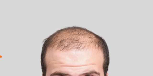 male pattern baldness