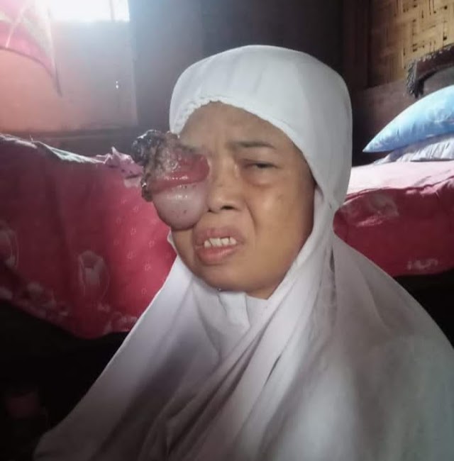 SEORANG IBU WARGA TANJUNG MORAWA PENDERITA TUMOR DI MATA, BUTUH PERHATIAN PEMERINTAH