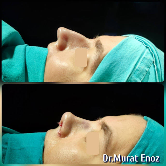 nose job,Natural rhinoplasty in Istanbul,Natural looking nasal aesthetic surgery,nose reshaping,