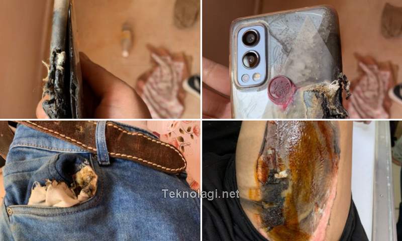 OnePlus Meledak dan Terbakar di Celana Jeans (twitter.com)