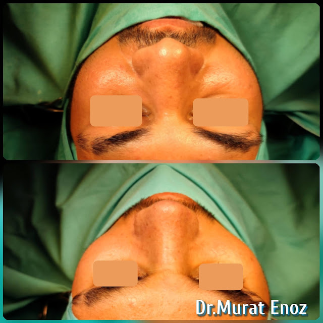 Natural nose aesthetic surgery for male,Male thick skinned rhinoplasty,Ethnic expert rhinoplasty surgeon,Ethnic Rhinoplasty in Istanbul,