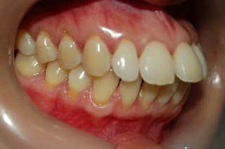 Tổng hợp những nguyên nhân răng bị hô mọi người nên biết-2