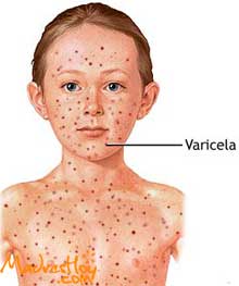 ¿Cómo se contrae la varicela?