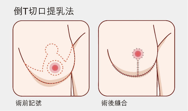 倒T切口縮胸手術示意圖