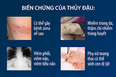 Những biến chứng của bệnh thủy đậu