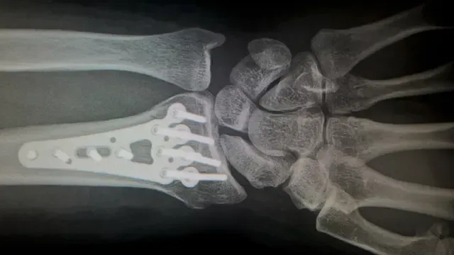 Les principales maladies des os, fracture osseuse, ostéosynthèse : réassemblage des fragments osseux