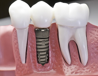 Cấy ghép răng implant là gì-1