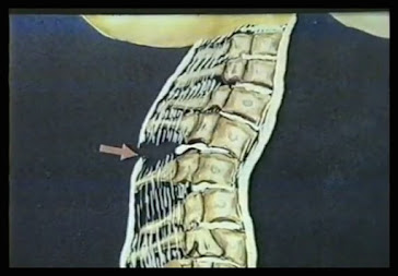Damage to the cervical vertebrae © The cervical vertebra