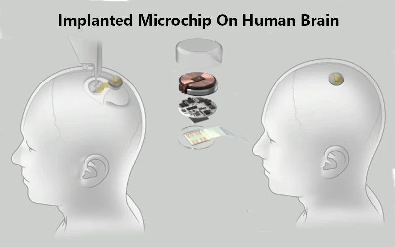 Elon Musk is working towards improving the lives of people with a broad range of patients with the Neuralink brain chip.