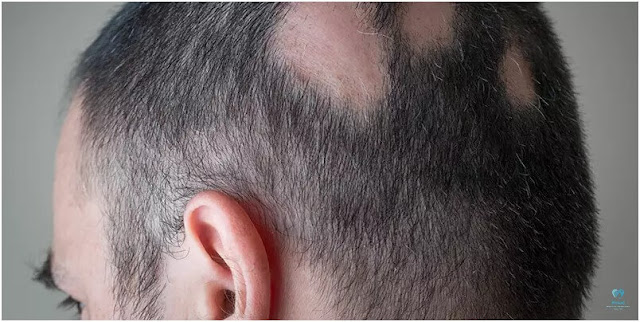 alopecia causes,what causes hair to fall out