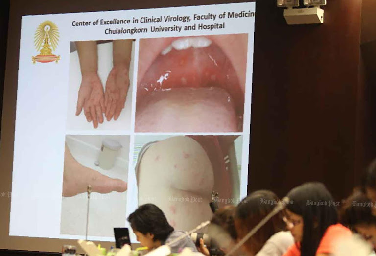 Thailand outbreak spotlights Hand, Foot, and Mouth Disease as climate shifts amplify threats.