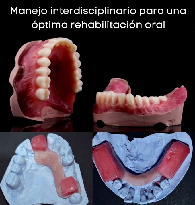 PDF: Manejo interdisciplinario para una óptima rehabilitación oral