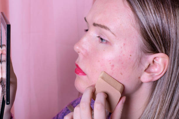 Young woman applying liquid foundation to cover acne, using a makeup sponge and looking in the mirror.