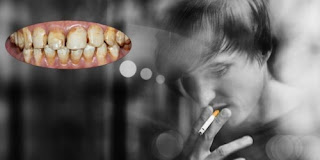 Làm trắng răng cho người hút thuốc lá-1