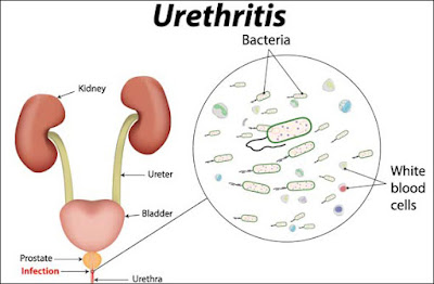 urethritis in Male