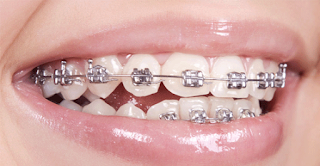 Quy trình niềng răng mắc cài cài kim loại-2