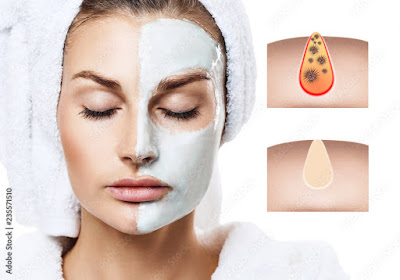 3. क्लोज्ड पोर्स मास्क (Clogged pores mask)