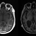 Vacina contra Alzheimer inicia fase de testes em humanos