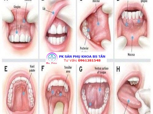 viêm lợi loét miệng ở trẻ