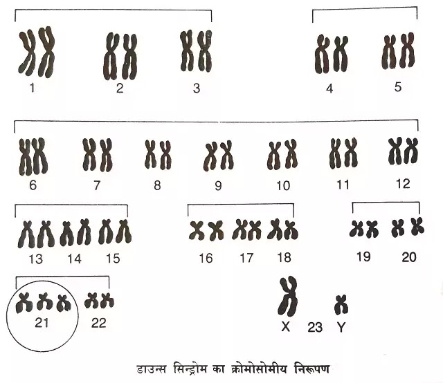 मानव गुणसूत्र संख्या में त्रुटियां- डाउन्स सिन्ड्रोम, टरनर्स सिन्ड्रोम|hindi